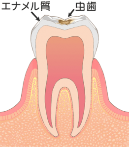 港区 虎ノ門 まさいデンタルクリニック C1　歯の表面（エナメル質）の虫歯