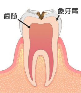 港区 虎ノ門 まさいデンタルクリニック C2　歯の中（象牙質）の虫歯