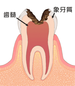 港区 虎ノ門 まさいデンタルクリニック C3　神経まで進行した虫歯