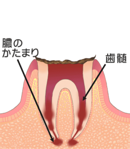 港区 虎ノ門 まさいデンタルクリニック C4　歯の根まで進行した虫歯